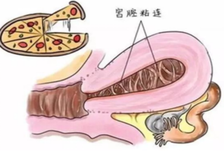 无处安放的种子——宫腔粘连，备孕女性路上的绊脚石！！
