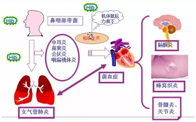 此“流”非“B流”！解密您不知道的b型流感嗜血杆菌疫苗